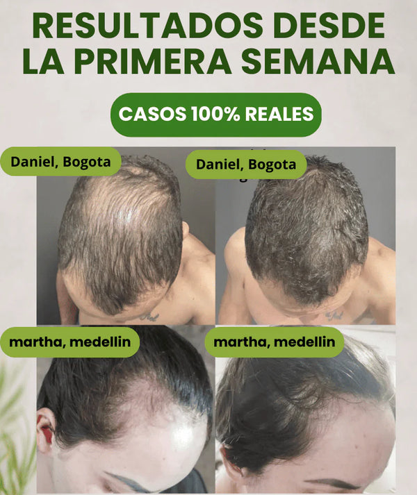 💇‍♀️ Batana Anti-Caída™ – Más Cabello, Menos Pérdida 🔥 Ayuda a fortalecer desde la raíz.