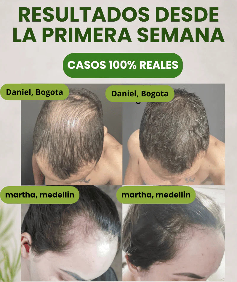 💇‍♀️ Batana Anti-Caída™ – Más Cabello, Menos Pérdida 🔥 Ayuda a fortalecer desde la raíz.