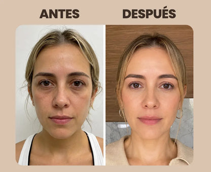 🔥 ¿Ojeras, bolsas y líneas de expresión te hacen ver cansada? ✨ Parches de Microagujas para Contorno de Ojos Perfecto ✨ 🎁 Compra 25 y llévate 5 de regalo