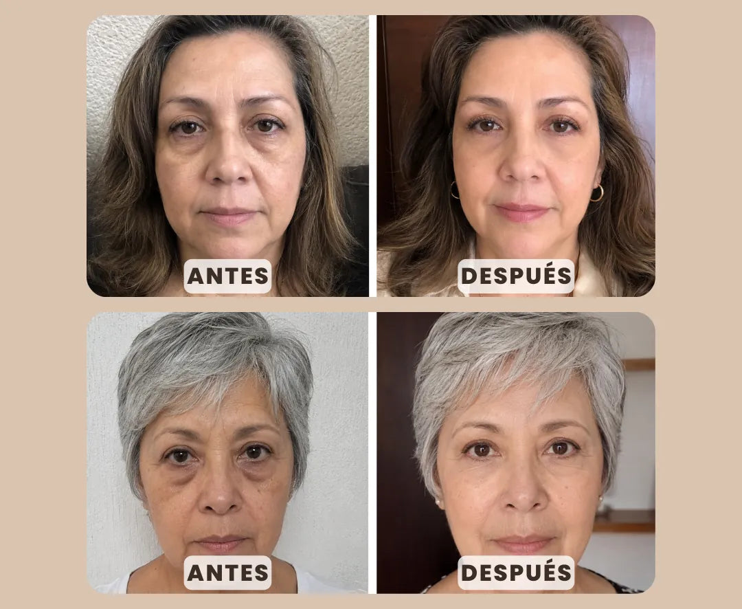 🔥 ¿Ojeras, bolsas y líneas de expresión te hacen ver cansada? ✨ Parches de Microagujas para Contorno de Ojos Perfecto ✨ 🎁 Compra 25 y llévate 5 de regalo
